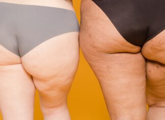 TUKOVÁ A VODOVÁ CELULITÍDA: Poznáte rozdiel a spôsoby, ako sa oboch čo najrýchlejšie ZBAVIŤ?